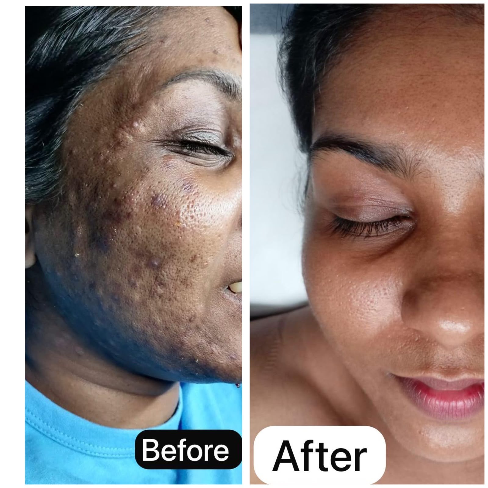 Acne Revision